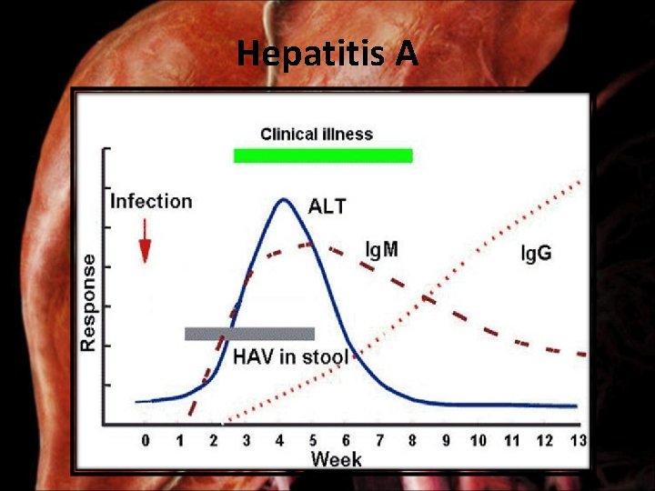 Hepatitis A 