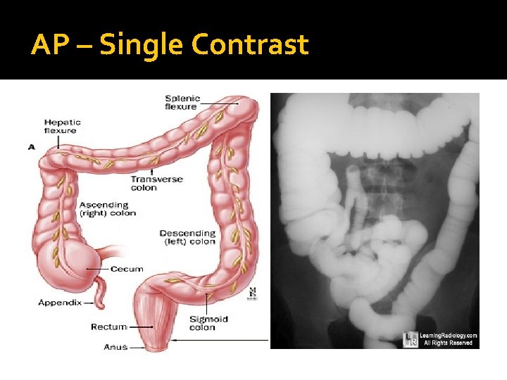 AP – Single Contrast 