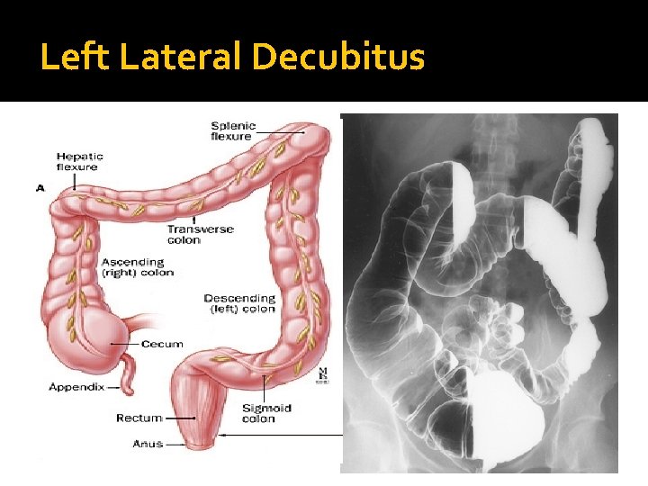 Left Lateral Decubitus 