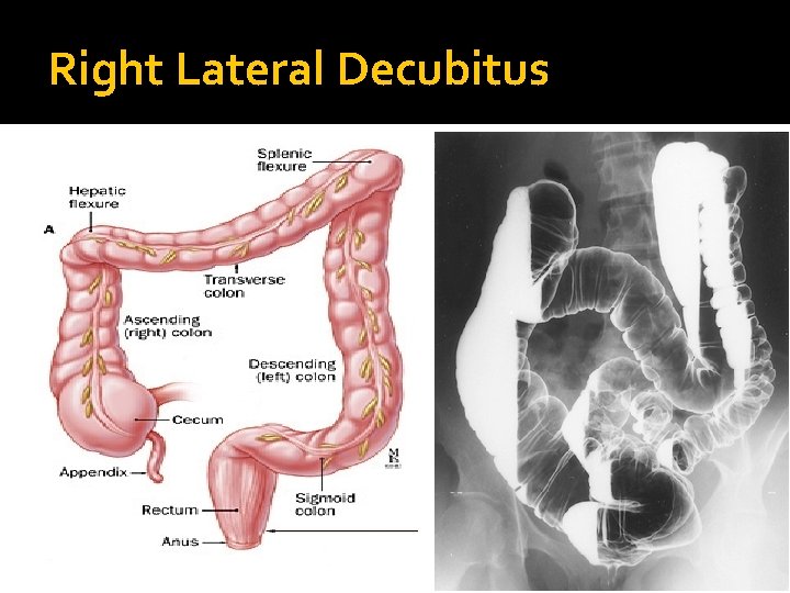 Right Lateral Decubitus 