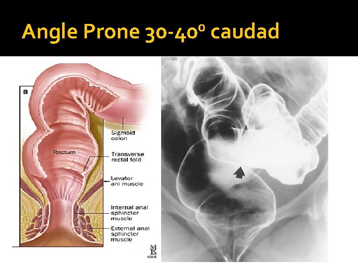 0 Angle Prone 30 -40 caudad 