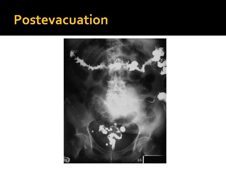 Postevacuation 