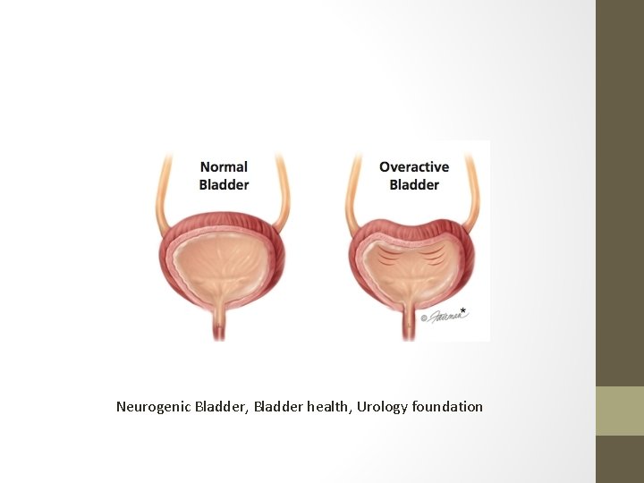 Neurogenic Bladder, Bladder health, Urology foundation 