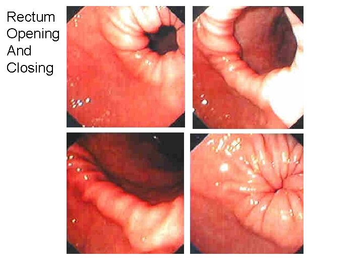 Rectum Opening And Closing 