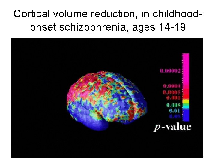 Cortical volume reduction, in childhoodonset schizophrenia, ages 14 -19 