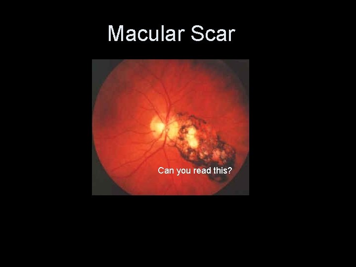 Macular Scar • Photo of macular scar Can you read this? 