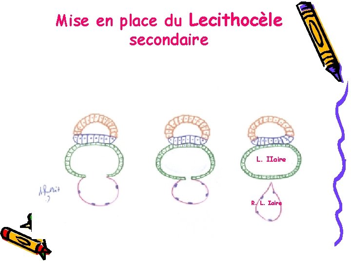 Mise en place du Lecithocèle secondaire L. IIaire R. L. Iaire 