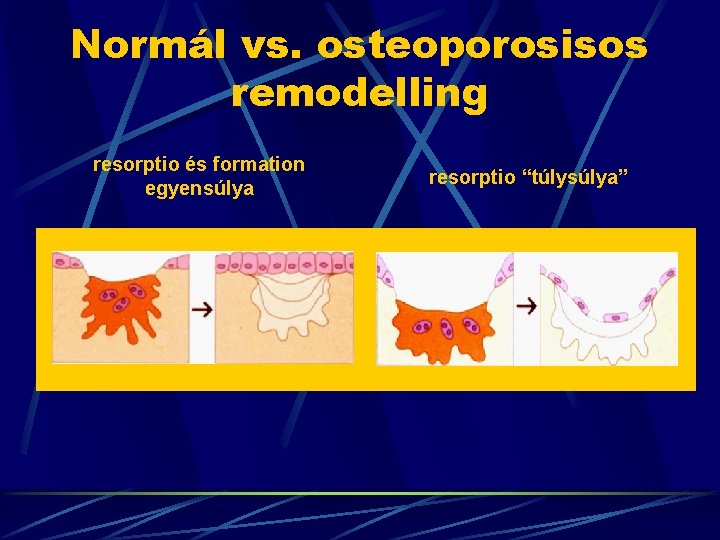 Normál vs. osteoporosisos remodelling resorptio és formation egyensúlya resorptio “túlysúlya” 