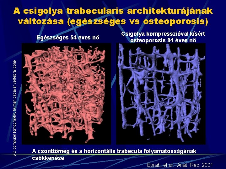 A csigolya trabecularis architekturájának változása (egészséges vs osteoporosis) 3 -D computer tomography, human cadaver