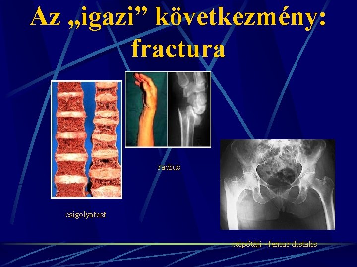 Az „igazi” következmény: fractura radius csigolyatest csípőtáji - femur distalis 