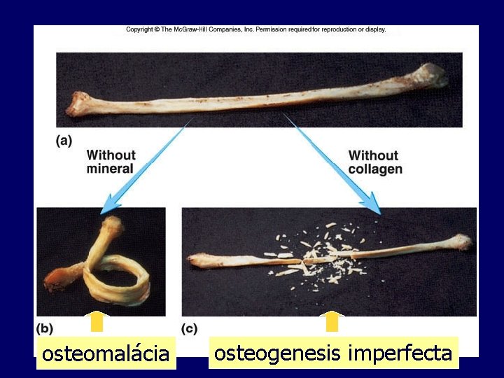 osteomalácia osteogenesis imperfecta 