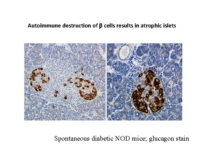 Autoimmune destruction of cells results in atrophic islets Spontaneous diabetic NOD mice; glucagon stain