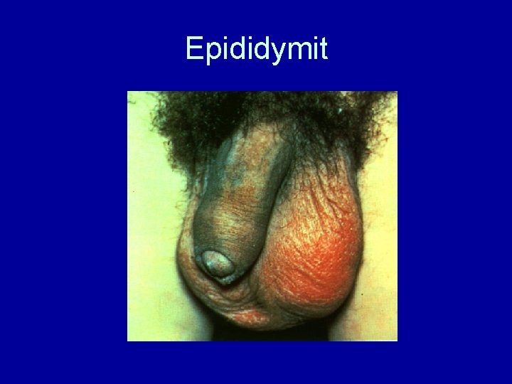 Epididymit 