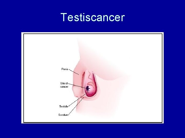 Testiscancer 