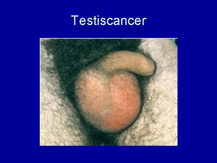 Testiscancer 