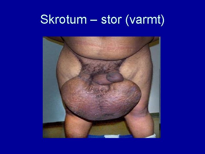 Skrotum – stor (varmt) 