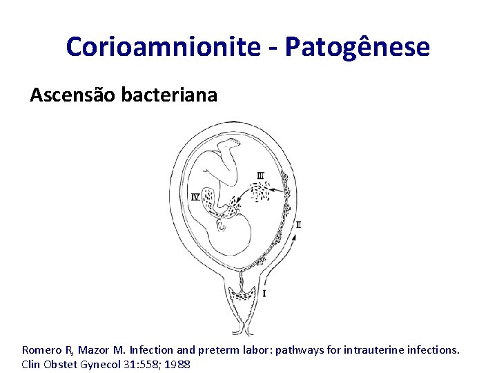 Corioamnionite - Patogênese Ascensão bacteriana Romero R, Mazor M. Infection and preterm labor: pathways