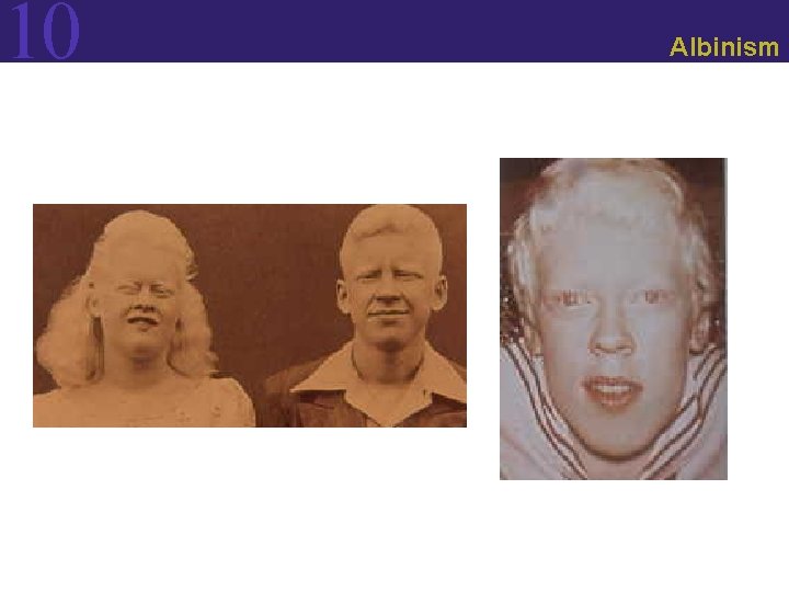 10 Albinism 