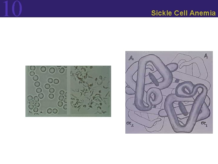 10 Sickle Cell Anemia 