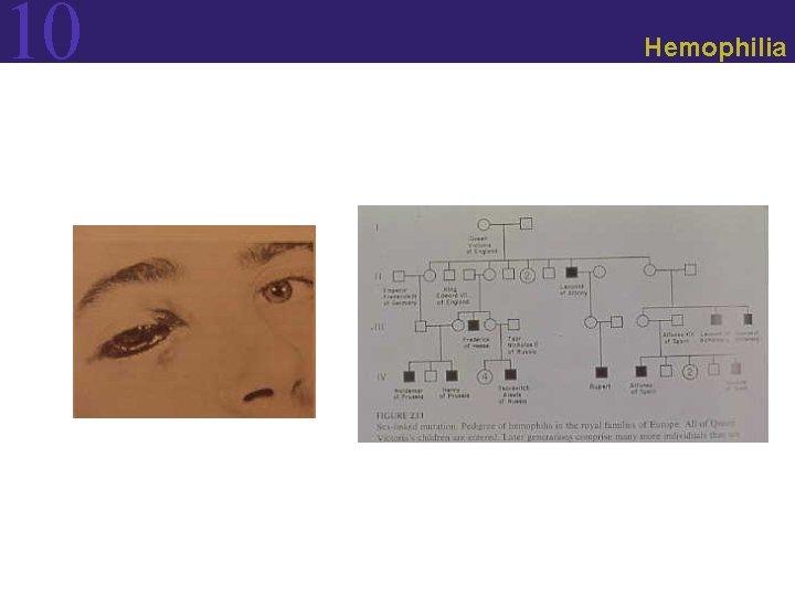 10 Hemophilia 10 Hemophilia