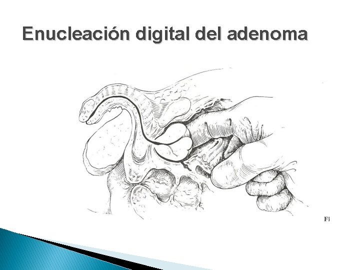 Enucleación digital del adenoma 