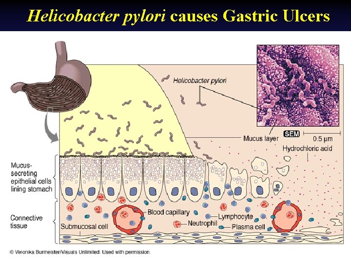 Helicobacter pylori causes Gastric Ulcers 