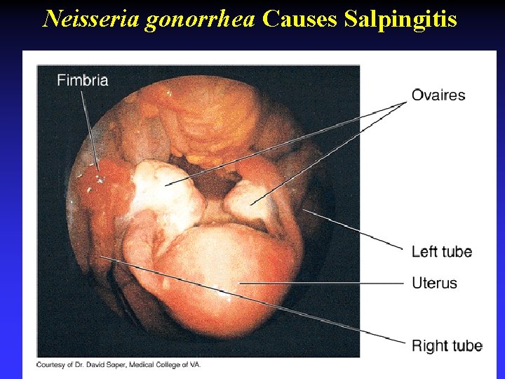 Neisseria gonorrhea Causes Salpingitis 