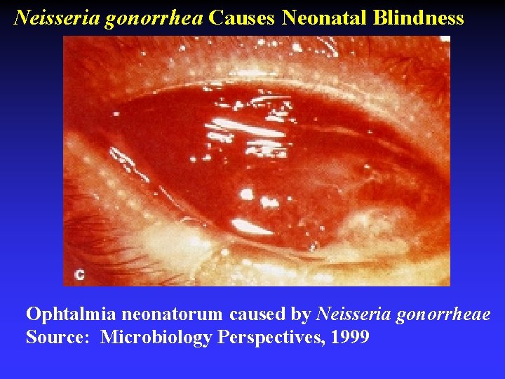 Neisseria gonorrhea Causes Neonatal Blindness Ophtalmia neonatorum caused by Neisseria gonorrheae Source: Microbiology Perspectives,