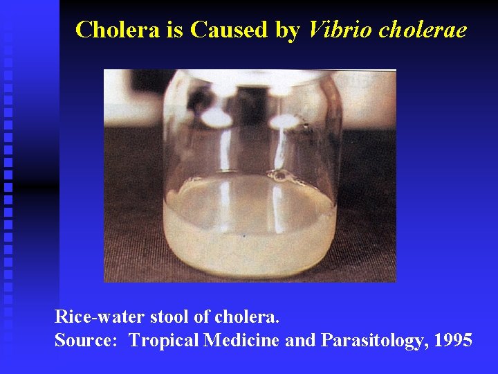 Cholera is Caused by Vibrio cholerae Rice-water stool of cholera. Source: Tropical Medicine and