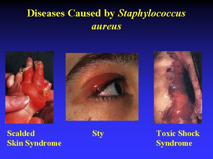 Diseases Caused by Staphylococcus aureus Scalded Skin Syndrome Sty Toxic Shock Syndrome 