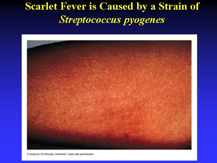 Scarlet Fever is Caused by a Strain of Streptococcus pyogenes 