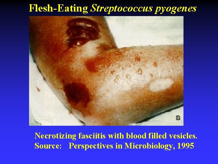 Flesh-Eating Streptococcus pyogenes Necrotizing fasciitis with blood filled vesicles. Source: Perspectives in Microbiology, 1995