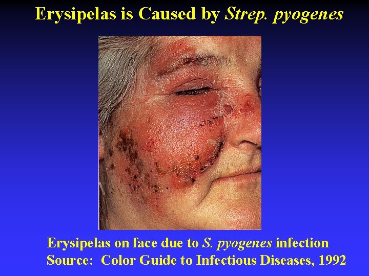 Erysipelas is Caused by Strep. pyogenes Erysipelas on face due to S. pyogenes infection