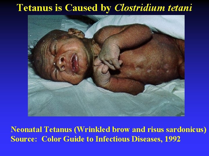 Tetanus is Caused by Clostridium tetani Neonatal Tetanus (Wrinkled brow and risus sardonicus) Source: