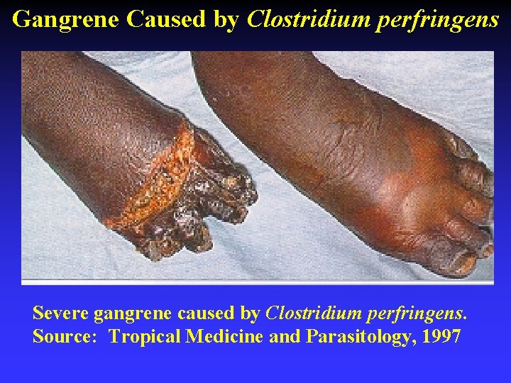 Gangrene Caused by Clostridium perfringens Severe gangrene caused by Clostridium perfringens. Source: Tropical Medicine