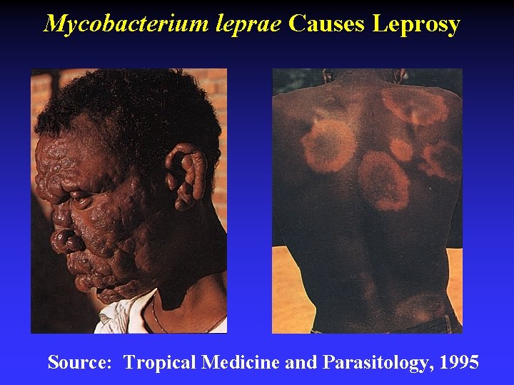 Mycobacterium leprae Causes Leprosy Source: Tropical Medicine and Parasitology, 1995 