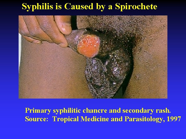 Syphilis is Caused by a Spirochete Primary syphilitic chancre and secondary rash. Source: Tropical