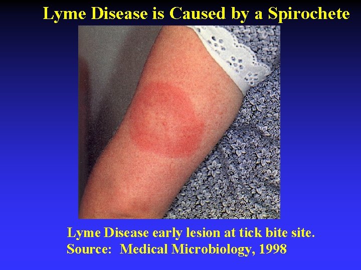 Lyme Disease is Caused by a Spirochete Lyme Disease early lesion at tick bite