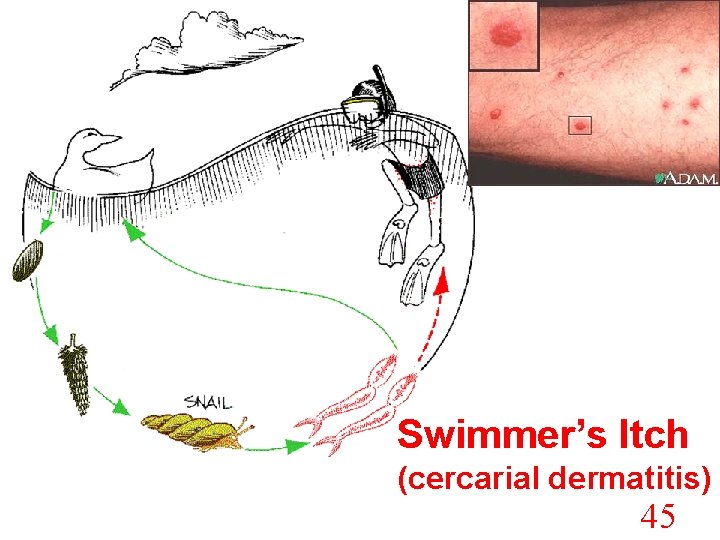 Swimmer’s Itch (cercarial dermatitis) 45 