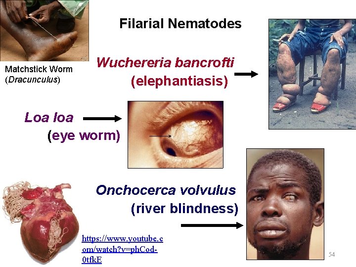Filarial Nematodes Matchstick Worm (Dracunculus) Wuchereria bancrofti (elephantiasis) Loa loa (eye worm) Onchocerca volvulus