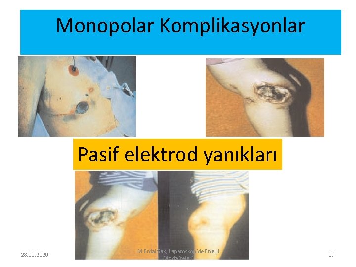 Monopolar Komplikasyonlar Pasif elektrod yanıkları 28. 10. 2020 M. Erdal Sak, Laparoskopide Enerji Modaliteleri