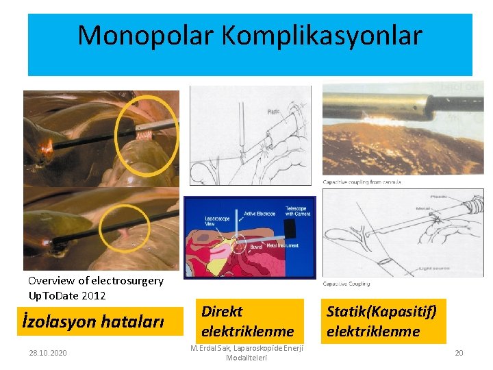 Monopolar Komplikasyonlar Overview of electrosurgery Up. To. Date 2012 İzolasyon hataları 28. 10. 2020