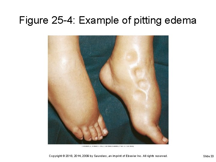 Figure 25 -4: Example of pitting edema Copyright © 2018, 2014, 2009 by Saunders,