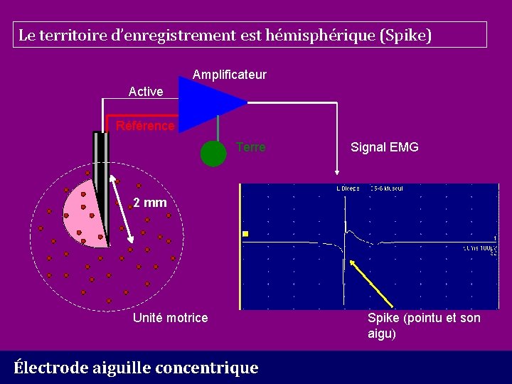 Le territoire d’enregistrement est hémisphérique (Spike) Amplificateur Active Référence Terre Signal EMG 2 mm