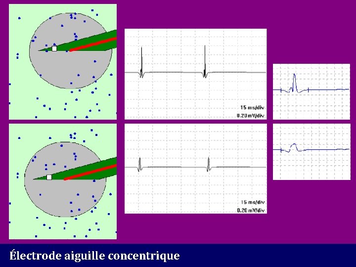 Électrode aiguille concentrique 