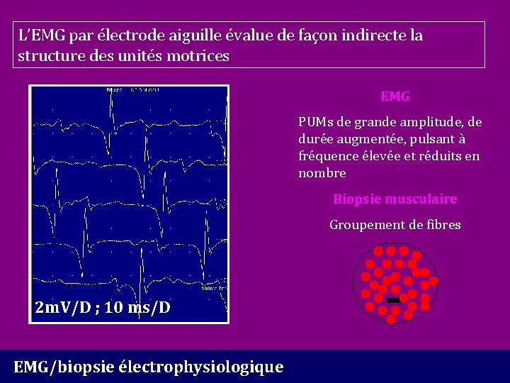 L’EMG par électrode aiguille évalue de façon indirecte la structure des unités motrices EMG