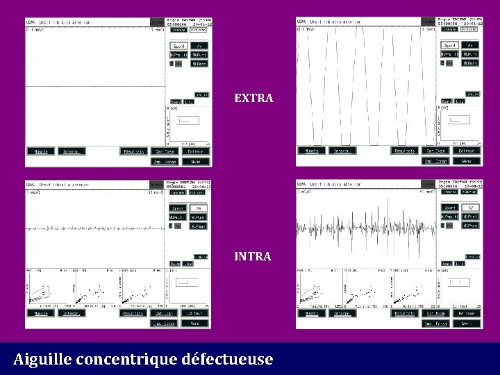 EXTRA INTRA Aiguille concentrique défectueuse 