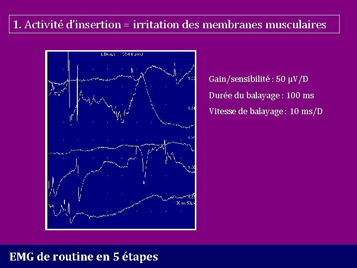 1. Activité d’insertion = irritation des membranes musculaires Gain/sensibilité : 50 µV/D Durée du