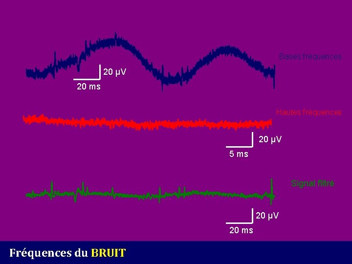 Bases fréquences 20 µV 20 ms Hautes fréquences 20 µV 5 ms Signal filtré