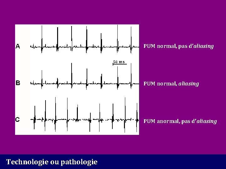 PUM normal, pas d’aliasing PUM normal, aliasing PUM anormal, pas d’aliasing Technologie ou pathologie